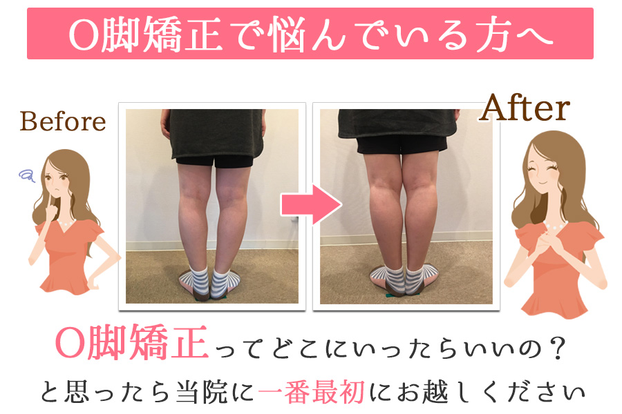 O脚 美脚矯正 大阪府茨木市の整骨院 腰痛治療なら茨木からだ整骨院